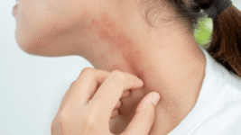 The Best Anti Itch Cream: How to Choose the Right Solution?